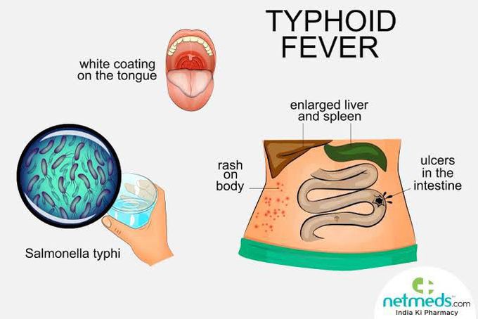 Typhoid