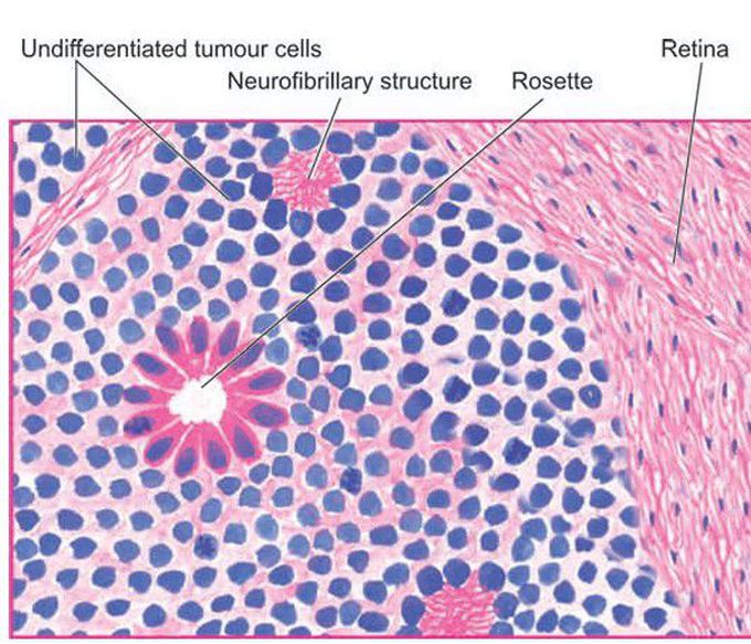 Retinoblastoma