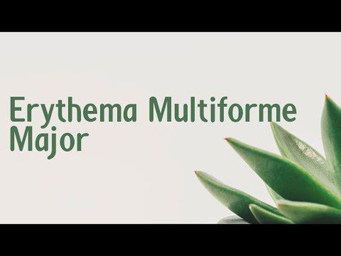 Quick overview of Erythema Multiform.