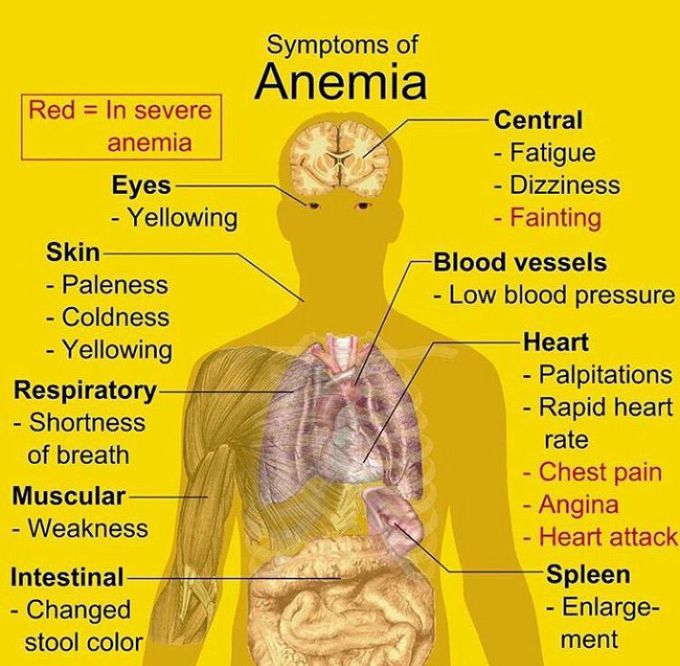 Anemia