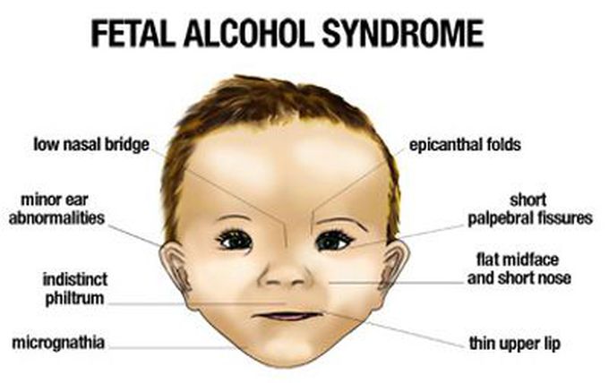 Foetal alcohol syndrome