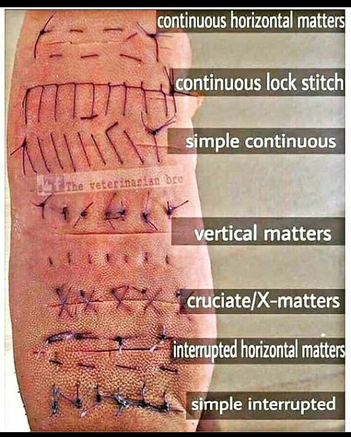 Types of Sutures - MEDizzy