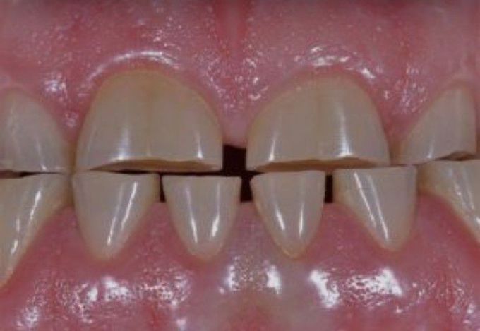 Bruxism