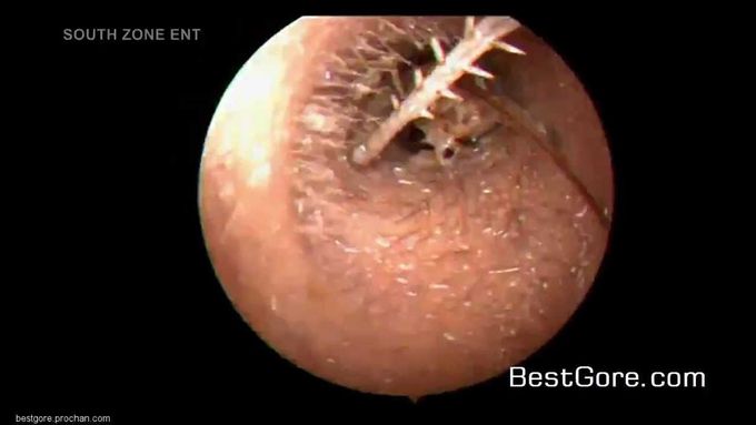 Live cricket inside the ear