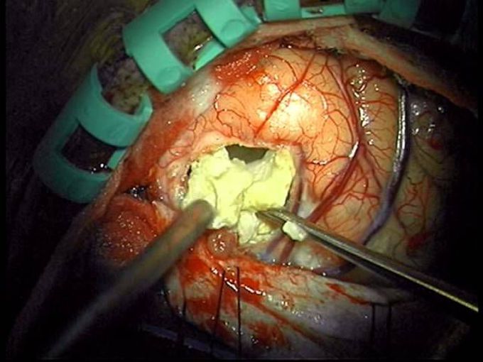 Removal of Epidermoid of Brain