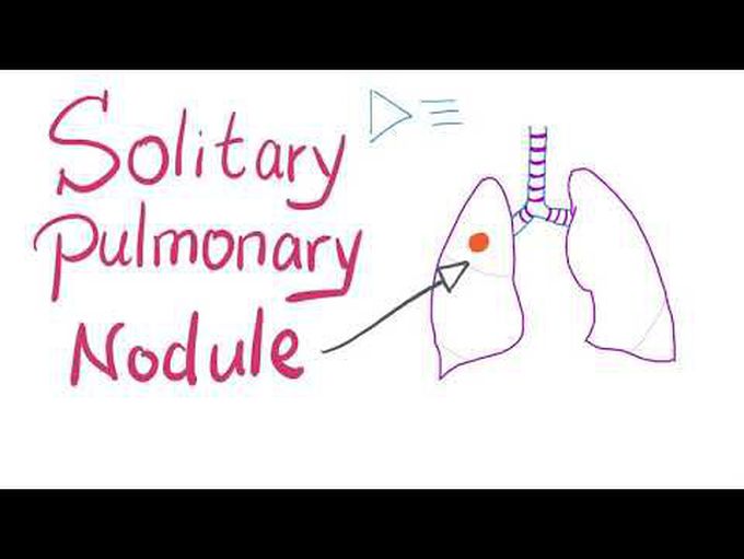 Solitary Pulmonary Nodule (SPN): How to manage it!