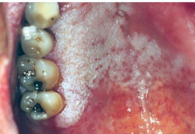 Proliferative verrucous leukoplakia