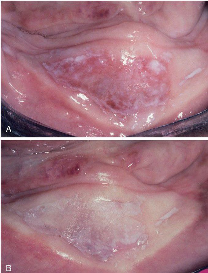 Candidal Leukoplakia.