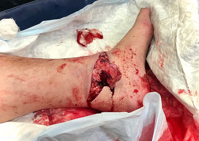 Open trimalleolar fracture with dislocation susp.