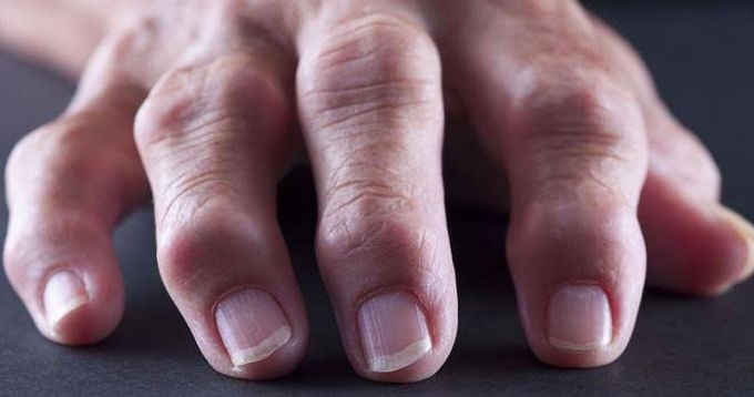 Cause of rheumatoid arthritis