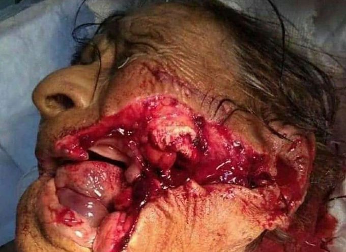 Accidents do not always happen to young people! This time severe trauma to the face of a seventy-year-old woman as a result of being stabbed by her bride!