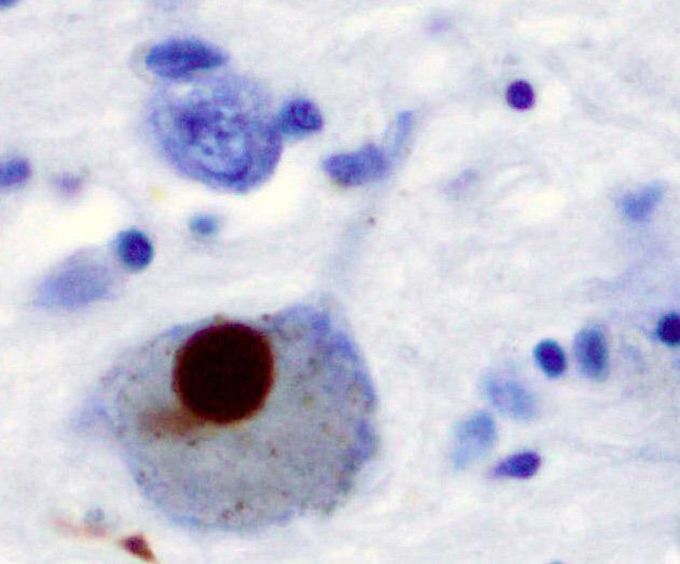 A lewy body (stained in brown)in a brain cell of the substantia nigra in Parkinson’s disease.
