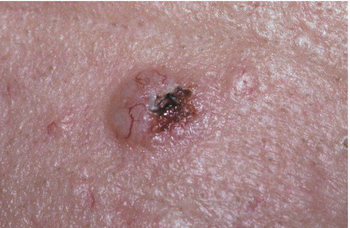 Basal Cell Carcinoma