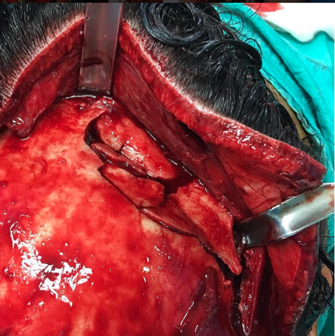 Emergency craniotomy