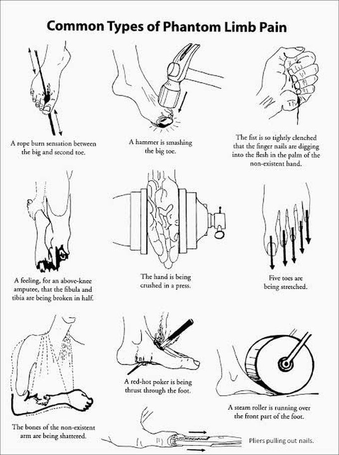 These are the types of Phantom Limb pain