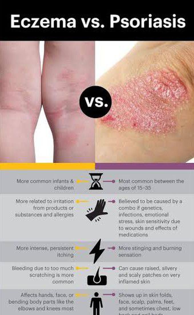 Eczema vs Psoriasis