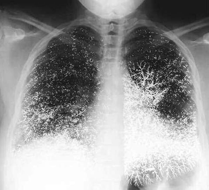 A strange view of the accumulation of mercury in pulmonary blood vessels.