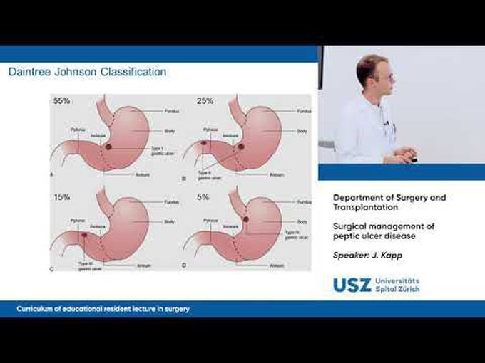 Peptic Ulcer Disease: Surgical Overview