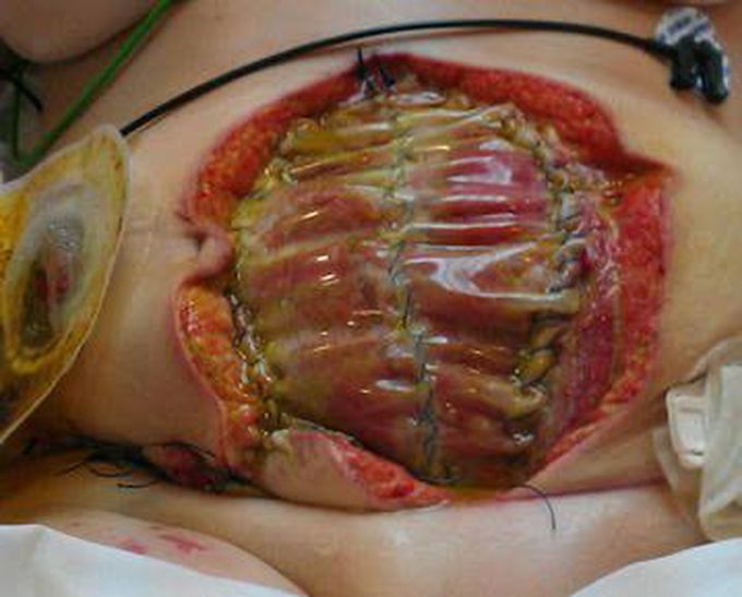 Open abdomen management