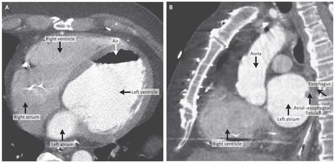 Gas in the Left Atrium and Ventricle