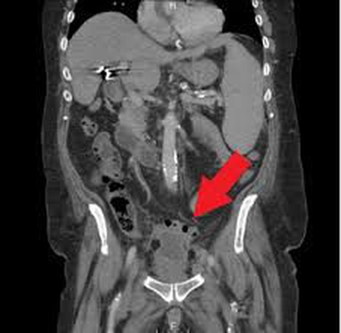 Pelvic Abscess