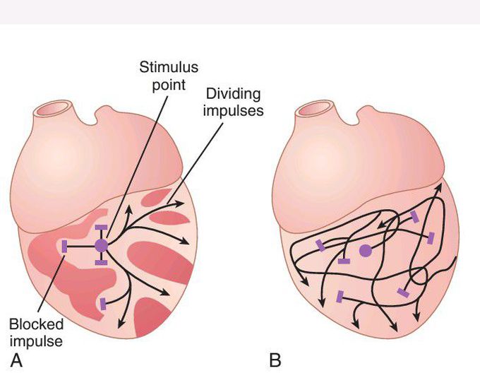 Atrial fibrillation