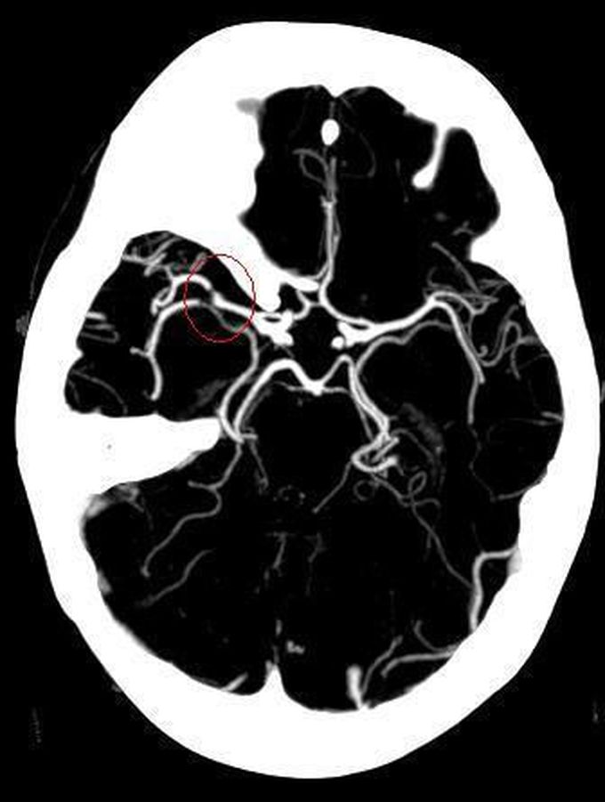 Ischemic stroke