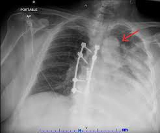 Lung Abscess symptoms