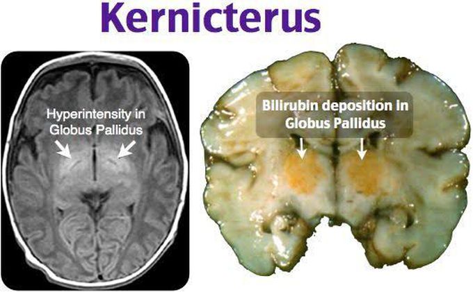 presentation of kernicterus