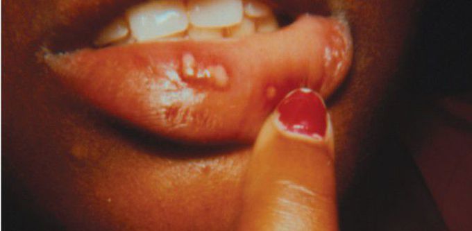 Primary herpes stomatitis