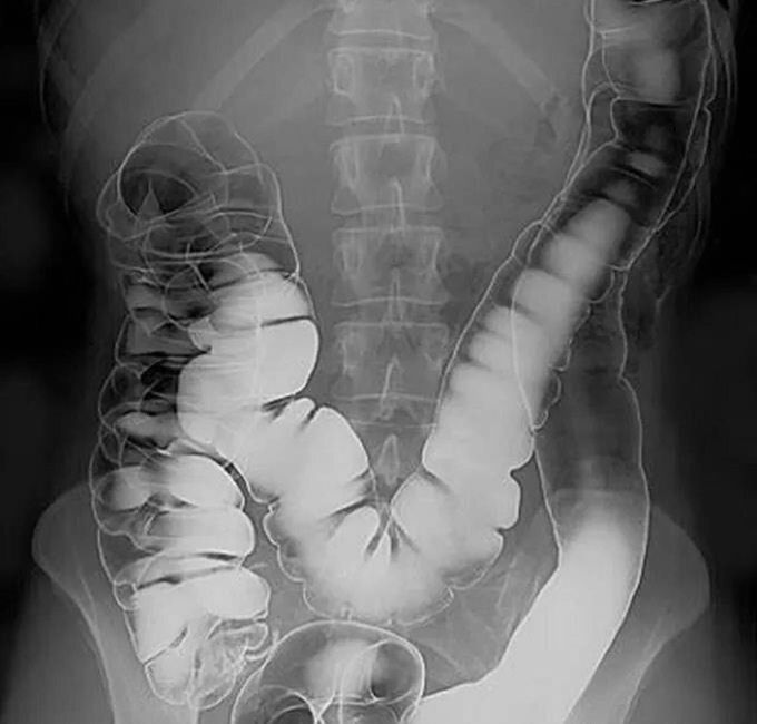 Rectal contrast
