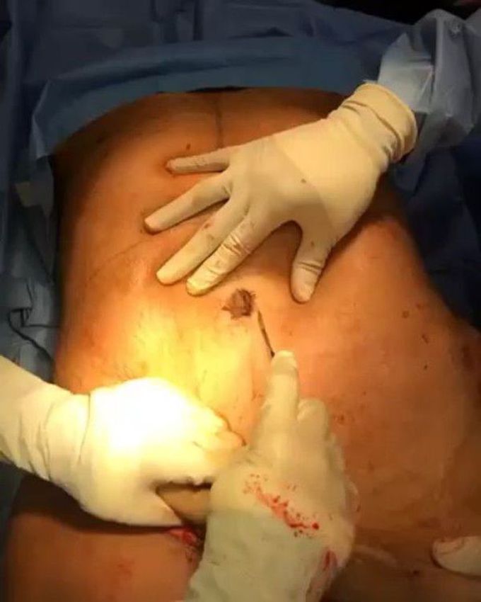 Tummy tuck surgery,
