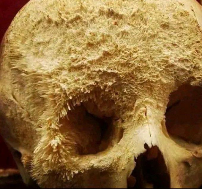 Bone cancer