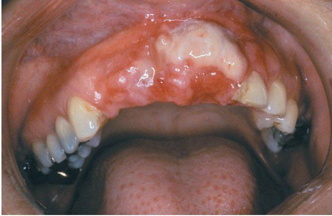 Leiomyosarcoma