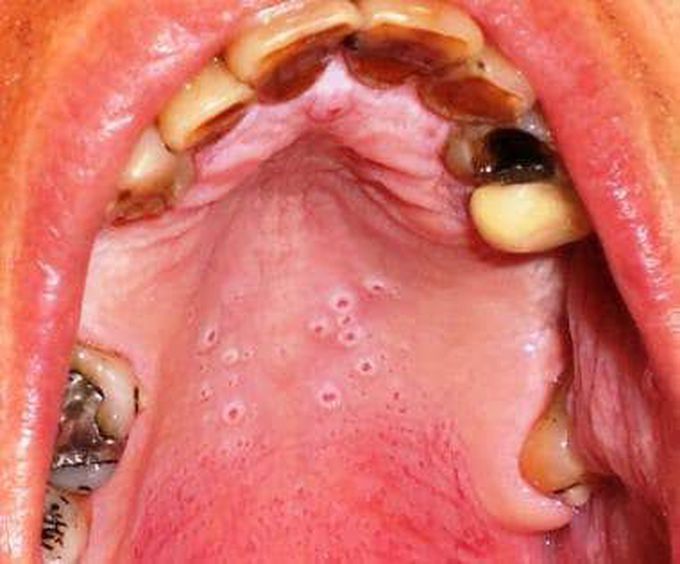 Nicotinic stomatitis symptoms