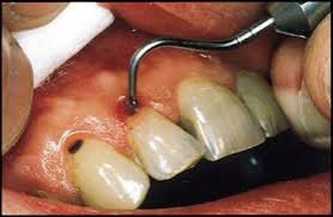 Removal of caries