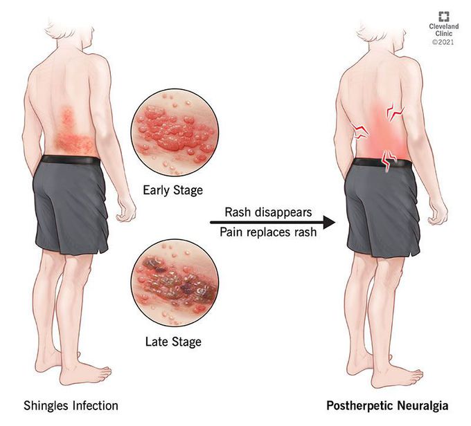 Postherpetic neuralgia medizzy