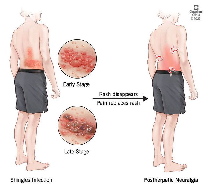 postherpetic neuralgia