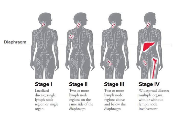 Stages of lymphoma