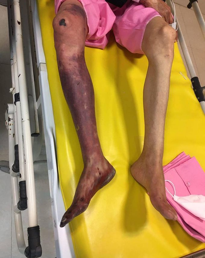 A 61 years old lady with limb ischemia due to right femoral artery embolism which was neglected. 