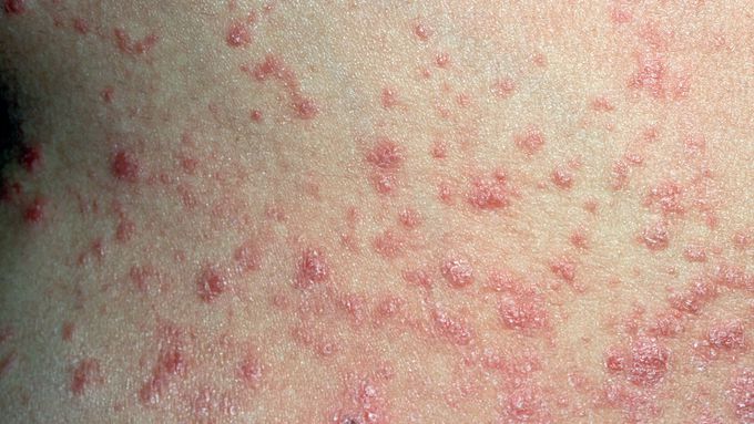 Symptoms of Guttate psoriasis