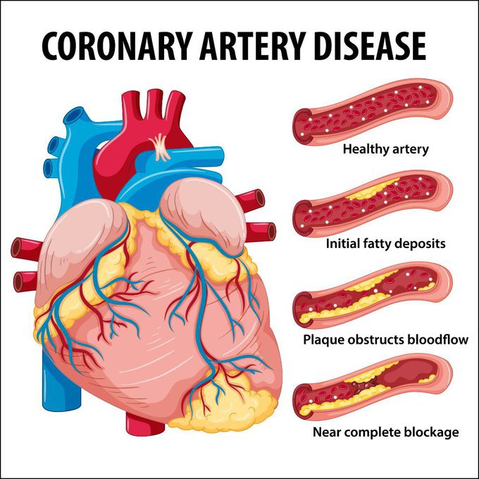 Coronary artery disease risk factors