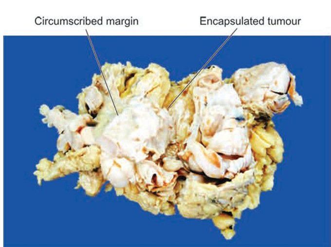 Benign breast tumor