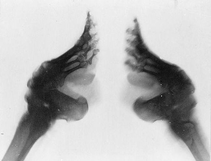An x-ray of a Chinese woman’s feet after being bound