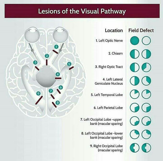 Rapid Revision of Optic pathway lesion