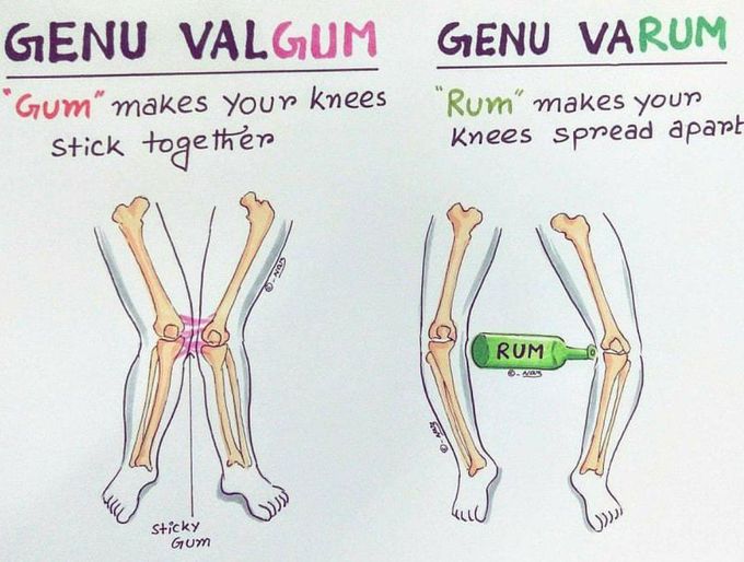 Genu valgum vs Genu valrum