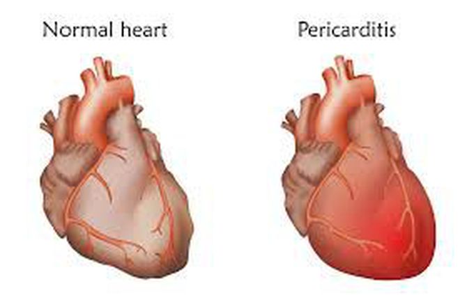 Symptoms of pericarditis