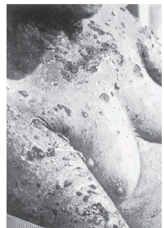 Pemphigus vulgaris.