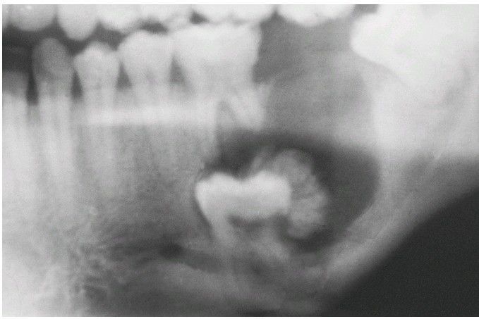 Calcifying Epithelial Odontogenic Tumor - MEDizzy