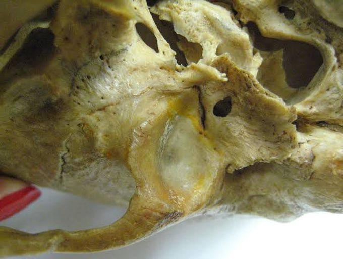 Foramen of Huschke